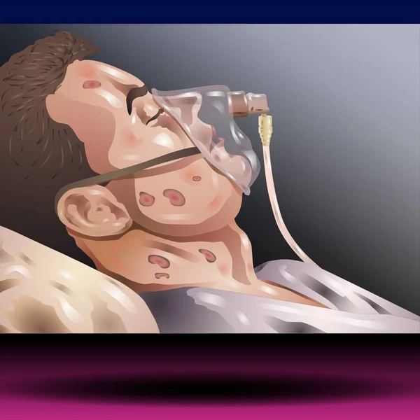 Patient with Oxygen Mask -  Man Patient in Hospital Having Artificial Lung Ventilation Being in Critical Condition Lying on Bed with Mask Vector - Fla source file available