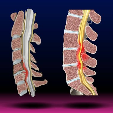 Spinal Stenoz - Fla kaynak dosyası mevcut - Spinal stenoz omuriliğe ve omurga içindeki sinirlere baskı yapabilir. Genellikle boynunda ve sırtının aşağısında olur. Bu durum genellikle yaşla ilgili yıpranma ve yıpranmadan kaynaklanır..