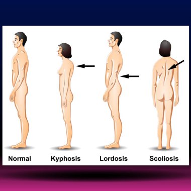 Omurga eğrileri - omurga eğrilerinin ya da sağlıksız omurgaların sembolü. İnsan omurgası anatomisi, kavisli omurga. - Fla kaynak dosyası mevcut - spine.coliosis 'in yan eğriliği genellikle ergenlik öncesi büyüme sırasında meydana gelir.