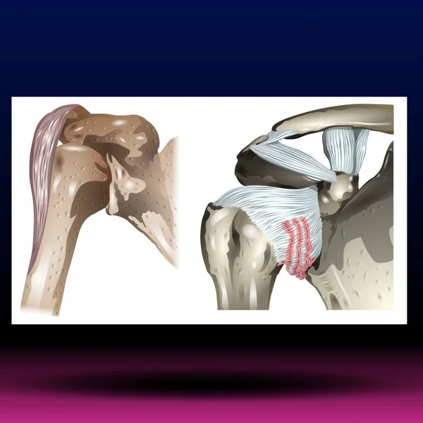 Frozen Shoulder - Fla source file available - Frozen shoulder occurs when the connective tissue enclosing the joint thickens and tightens. Frozen shoulder, also called adhesive capsulitis, involves stiffness and pain in the shoulder joint.