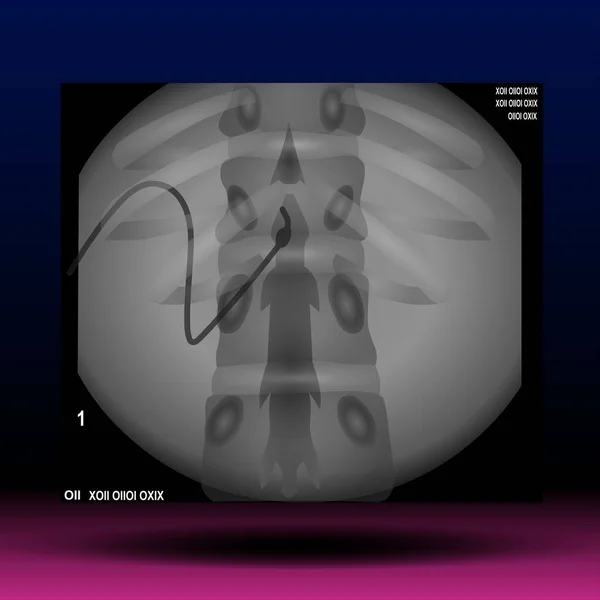 Omurga X-ray - Fla kaynak dosyası mevcut - Skolyoz omurganın anormal bir yan eğriliğidir.