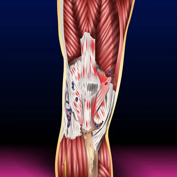 Leg - Fla kaynak dosyasındaki tendinit tendonun iltihaplanması veya tahriş olmasıdır. Kemiğe kas bağlayan kalın fibröz kordlar. Bu durum eklem yerinin hemen dışında acıya ve hassasiyete neden olur..