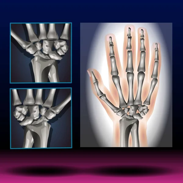 Wrist Anatomy - Fla source file available  - Carpal bones. Human hand anatomy. small bones of the wrist: Scaphoid, Lunate, Triquetrum, Pisiform, Trapezium, Trapezoid, Capitate and Hamate. Vector illustration