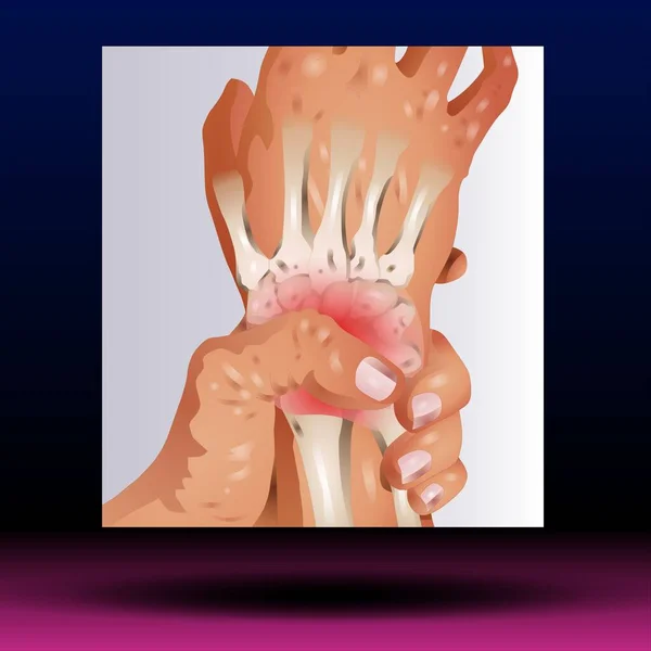 Wrist Pain - Fla source file available - Wrist pain is often caused by sprains or fractures from sudden injuries. But wrist pain can also result from long-term problems, such as repetitive stress, arthritis and carpal tunnel syndrome.