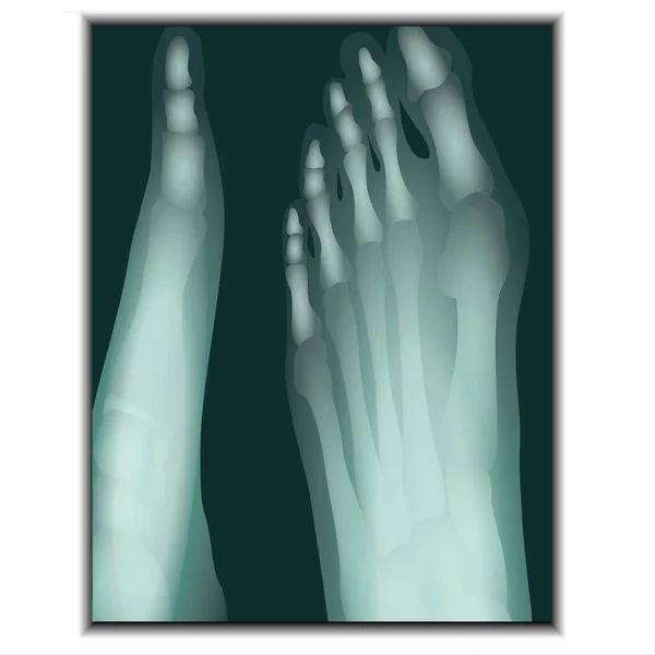 Рентгеновский Снимок Ноги Исходный Файл Fla Доступен — стоковое фото