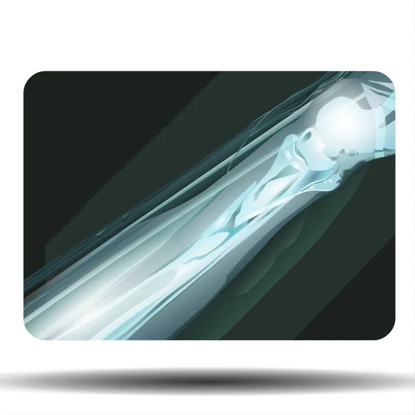 Kırık Kemik X-ray - Fla kaynak dosyası kullanılabilir