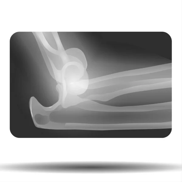 Kırık ayak bileği kemiğinin X-ray 'i - Fla kaynak dosyası kullanılabilir - Ayak bileği kaval kemiği (bacak kemiği) bacak tarafının röntgeni ve görünümü