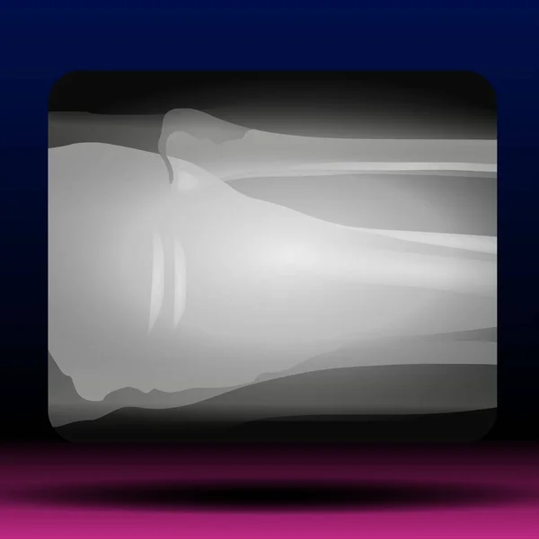 Kırık ayak bileği kemiğinin X-ray 'i - Fla kaynak dosyası kullanılabilir - Ayak bileği kaval kemiği (bacak kemiği) bacak tarafının röntgeni ve görünümü