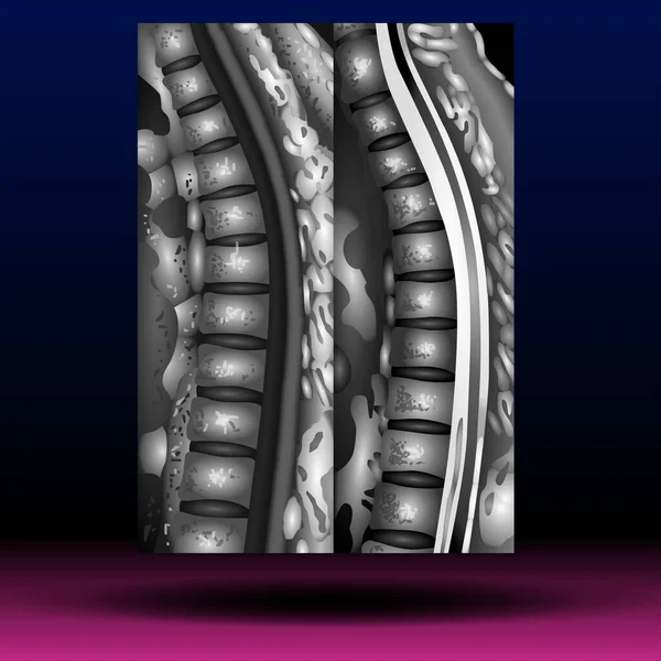 Kırık ayak bileği kemiğinin X-ray 'i - Fla kaynak dosyası kullanılabilir - Ayak bileği kaval kemiği (bacak kemiği) bacak tarafının röntgeni ve görünümü