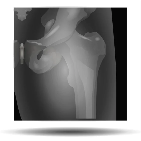 Deformasyonların X-Ray 'i - Fla kaynak dosyası mevcut - Romatoid artrit elinin röntgen filmi el ekleminde daralma gösteriyor. Röntgende romatoid artrit hastasının eli. Tıbbi ve sağlık sigortası aşısı. Radyoloji kavramı.