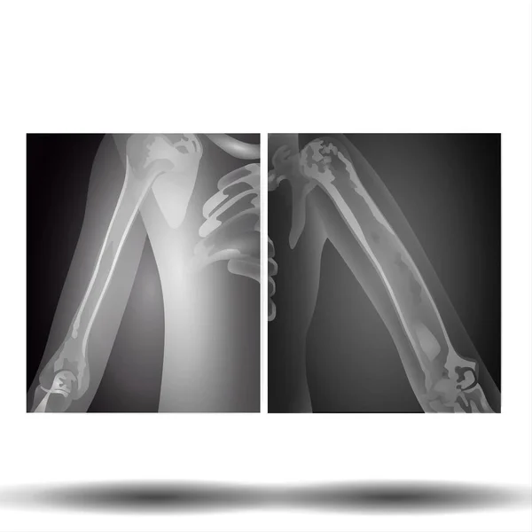 Ray Hand Upper Limb Fla Source File Available Membro Superior — Fotografia de Stock