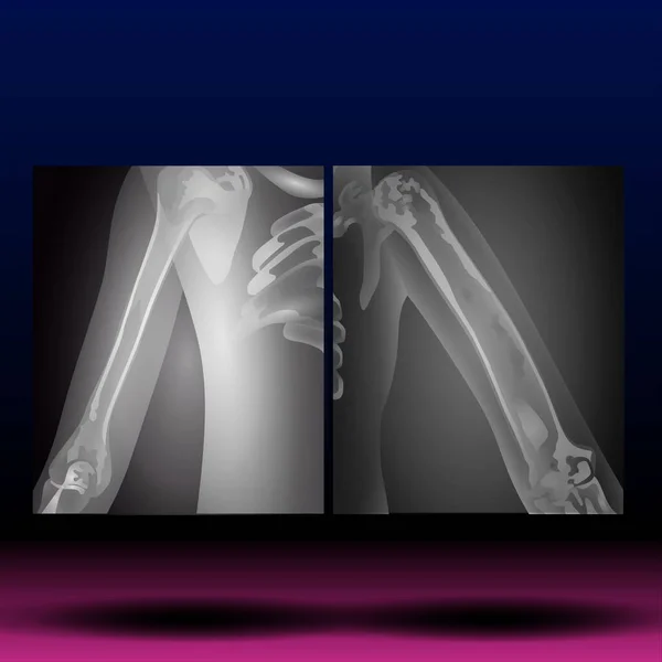 Ray Hand Upper Limb File Sorgente Fla Disponibile Arto Superiore — Foto Stock