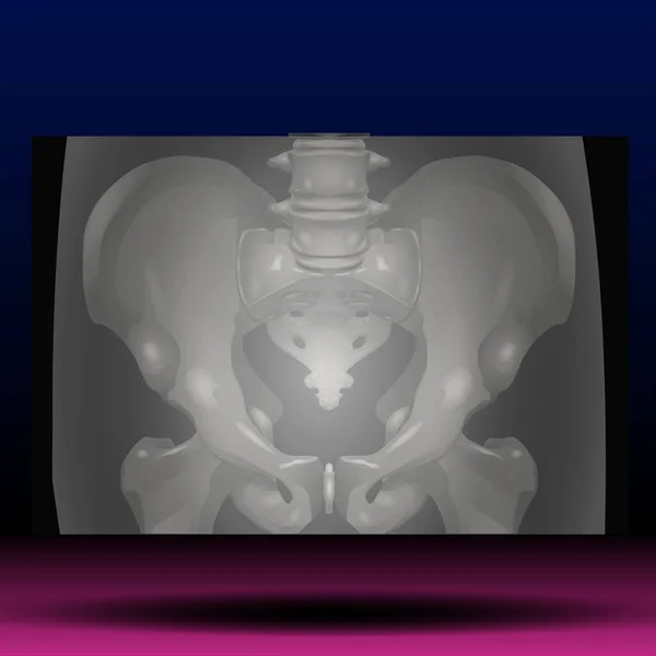 pelvis röntgeni