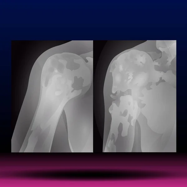 X-Ray of Shoulder - Fla source file available - x-ray images of the shoulder joint modified coracoclavicular stabilizer to see injuries bones and tendons for a medical diagnosis. Medical image concept and copy space.