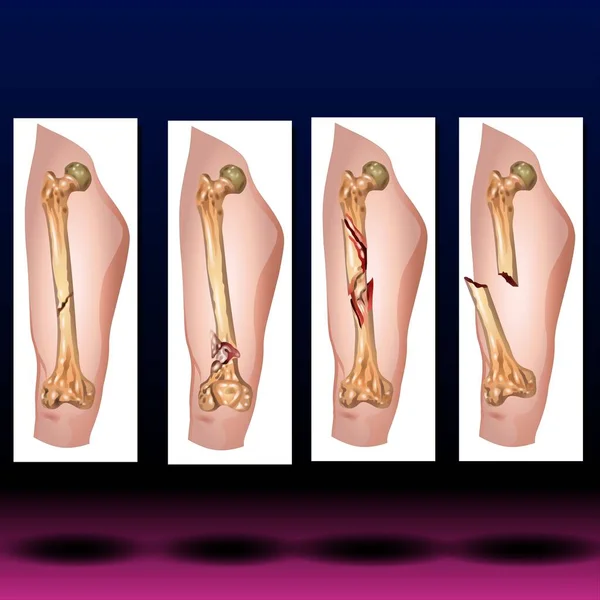 Fla 파일을 이용할 수있다 대퇴골은 몸에서 뼈이다 그것은 우리가 균형을 로열티 프리 스톡 사진