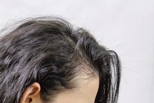 Female hairloss. Sad young woman with hair loss problem. Hair Loss problems. Woman with serious hair loss problem for health care