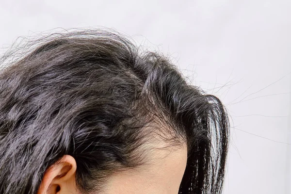 Weiblicher Haarausfall Traurige Junge Frau Mit Haarausfall Problem Haarausfall Probleme lizenzfreie Stockbilder