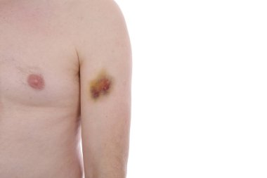 Olgun bir adamın elinde büyük bir çürük..