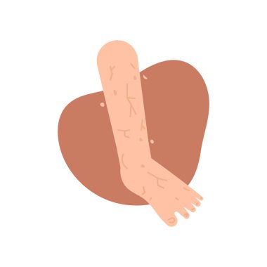 Xerosis, a dry and peeling skin condition. the skin on the feet is scaly and dry. lack of moisture in the skin and lack of water content. health. flat cartoon illustration. vector concept design