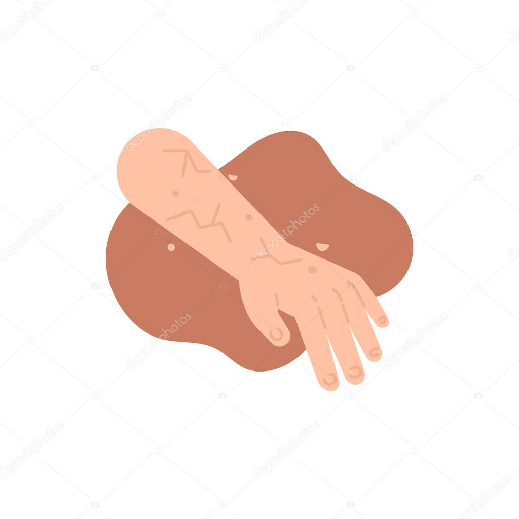 Xerosis, a dry and peeling skin condition. the skin on the arms is scaly and dry. lack of moisture in the skin and lack of water content. health. flat cartoon illustration. vector concept design