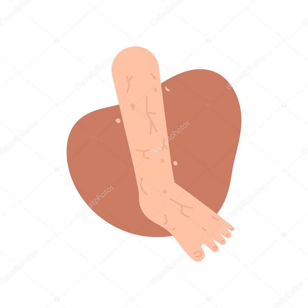 Xerosis, a dry and peeling skin condition. the skin on the feet is scaly and dry. lack of moisture in the skin and lack of water content. health. flat cartoon illustration. vector concept design