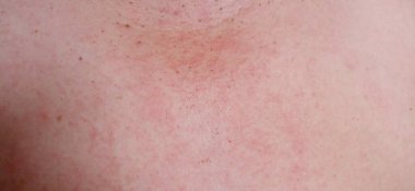 The red rash is caused by allergic reactions to food, chemicals, drugs, etc. on the epidermis.
