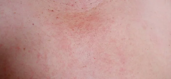 Red Rash Caused Allergic Reactions Food Chemicals Drugs Etc Epidermis — Stok Foto