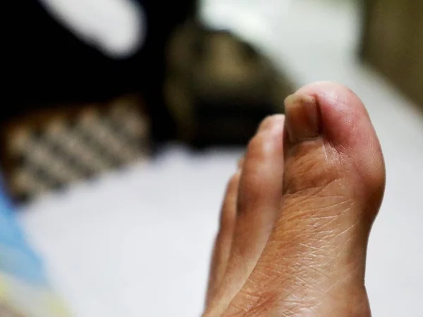 grandma\'s big toe looks wrinkled and dry due to lack of regular care