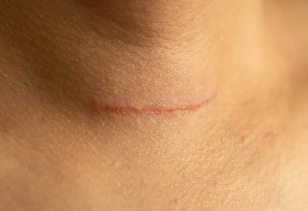 Close Photo Woman Surgical Wound Accured Due Goiter Surgery Thyroid — Stockfoto