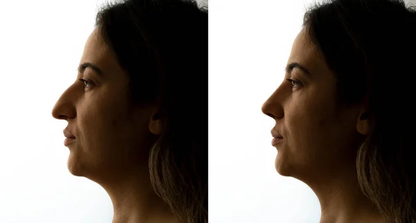 Photo Woman Who Had Aesthetic Nose Operation Aesthetic Surgery Beauty — Stockfoto