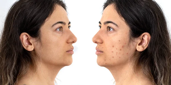 Close Photo Woman Excessive Amount Pimples Face Concept Beauty Skin — ストック写真