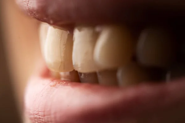 Close Photo Woman Cracked Teeth Teeth Care Concept Selective Focus — Stock Photo, Image