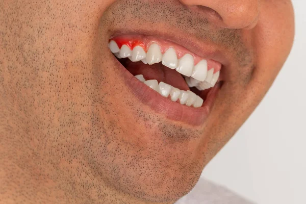 Close Photo Brown Skinned Young Adult Man Gum Inflammation Teeth — Stock Photo, Image