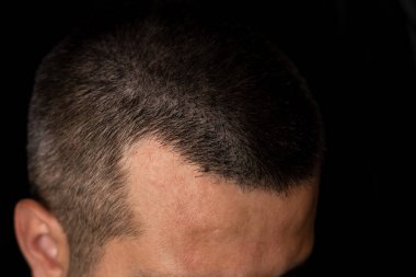 Close up photo of a man with hair loss clipart