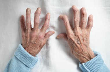 Rheumatoid arthritis of the hands of an elderly 90 year old woman on a white background.