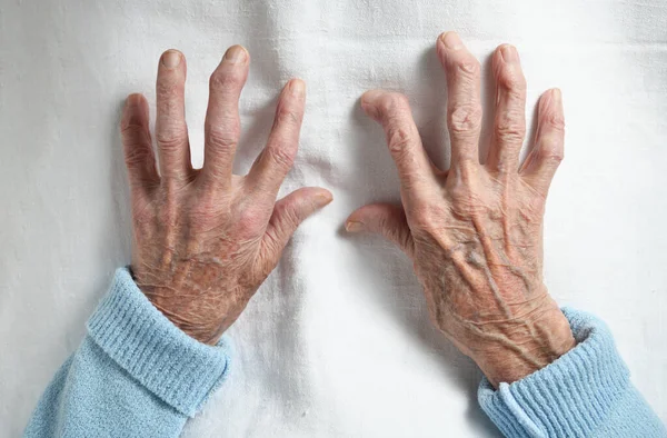 Rheumatoid arthritis of the hands of an elderly 90 year old woman on a white background.