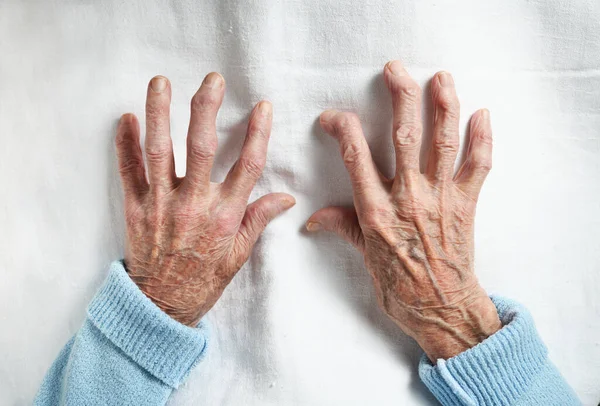 Rheumatoid arthritis of the hands of an elderly 90 year old woman on a white background.