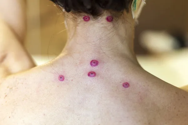 Hirudoterapia Marcas Mordedura Sanguijuela Espalda Chica Tratamiento Con Sanguijuelas —  Fotos de Stock