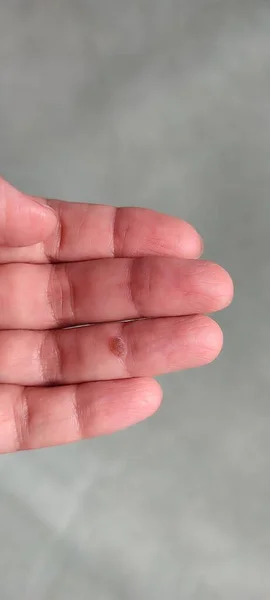 clavus on a human finger. dermatology problem
