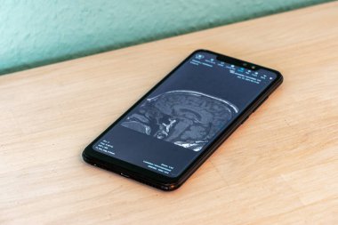 MRI Image of a Human Brain shown on a Smartphone Screen, concept of well-informed patients