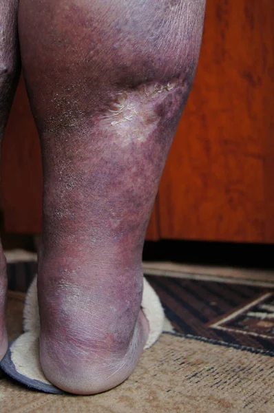 Wounds from varicose veins on the legs. Blue on the legs from varicose veins. Treatment of the legs. Evil sores on the legs. Treatment of blood vessels.