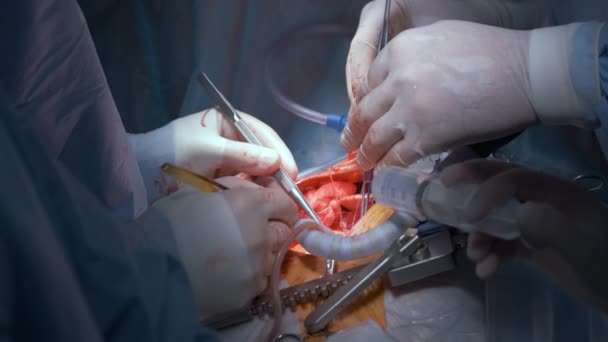 Närbild av professionell läkare händer som driver en patient under öppen hjärtkirurgi i kirurgiskt rum. Koncept för hälso- och sjukvård — Stockvideo