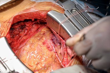 Cerrahi odasındaki açık kalp ameliyatı sırasında bir hastayı ameliyat eden profesyonel doktorların yakınlaşması. Sağlık ve tıbbi müdahale kavramı