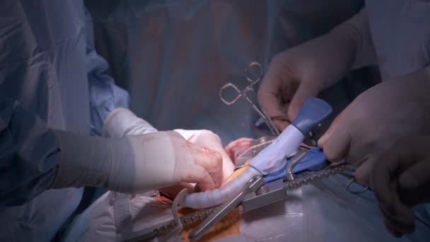 Крупный план профессиональных рук врача, оперирующих пациента во время операции на открытом сердце в хирургическом кабинете. Концепция здравоохранения и медицинского вмешательства — стоковое видео