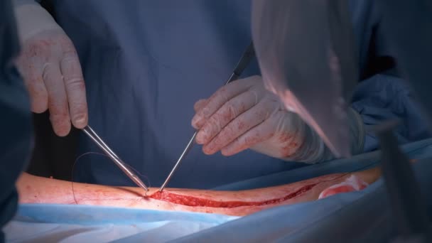 Een close-up van artsen die een patiënt opereren die een open operatie uitvoert in een operatiekamer. Begrip gezondheidszorg en medische interventie — Stockvideo