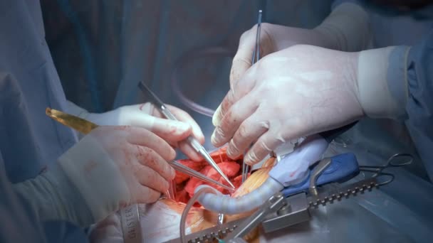 Nahaufnahme professioneller Arzthände, die einen Patienten während einer Operation am offenen Herzen im Operationssaal operieren. Gesundheitswesen und medizinisches Interventionskonzept — Stockvideo