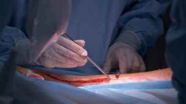 Cerrahi odasında açık ameliyat yapan bir hastayı ameliyat eden doktorların elleri. Sağlık ve tıbbi müdahale kavramı