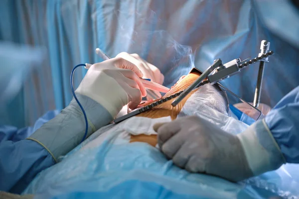 Команда професійних лікарів, які працюють з пацієнтом, проводять операцію відкритого перерізу в хірургічній кімнаті. Концепція медичного та медичного втручання — стокове фото