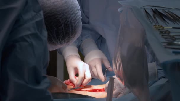 Equipo de médicos profesionales que operan a un paciente que realiza una cirugía de corte abierto en la sala de cirugía. Concepto de asistencia sanitaria e intervención médica — Vídeos de Stock