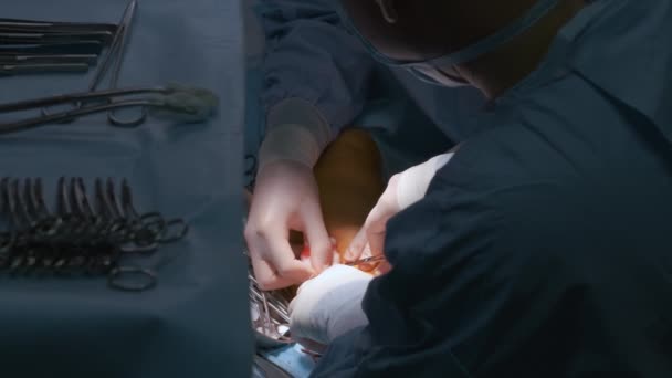 Equipo de médicos profesionales que operan a un paciente que realiza una cirugía de corte abierto en la sala de cirugía. Concepto de asistencia sanitaria e intervención médica — Vídeos de Stock